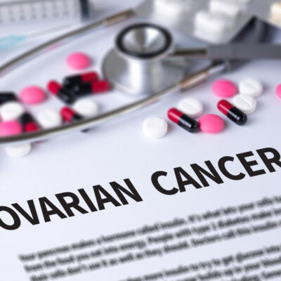 Risk Factors for Ovarian Cancer